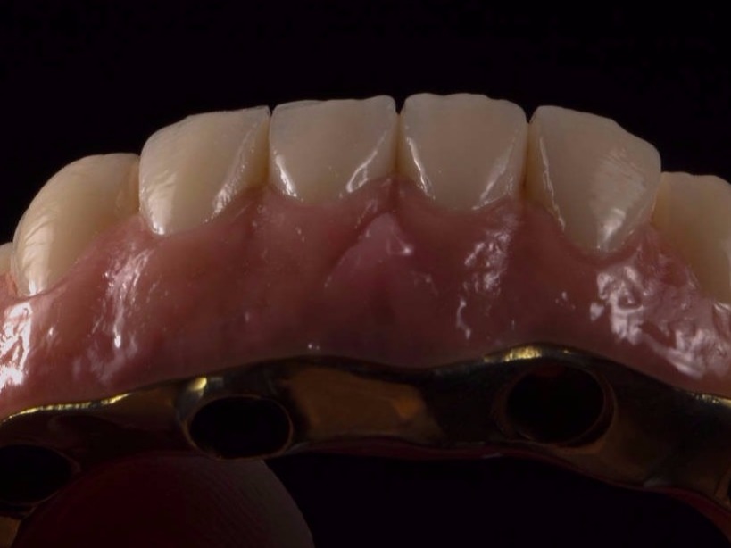 zirconio, protesis dental, implante