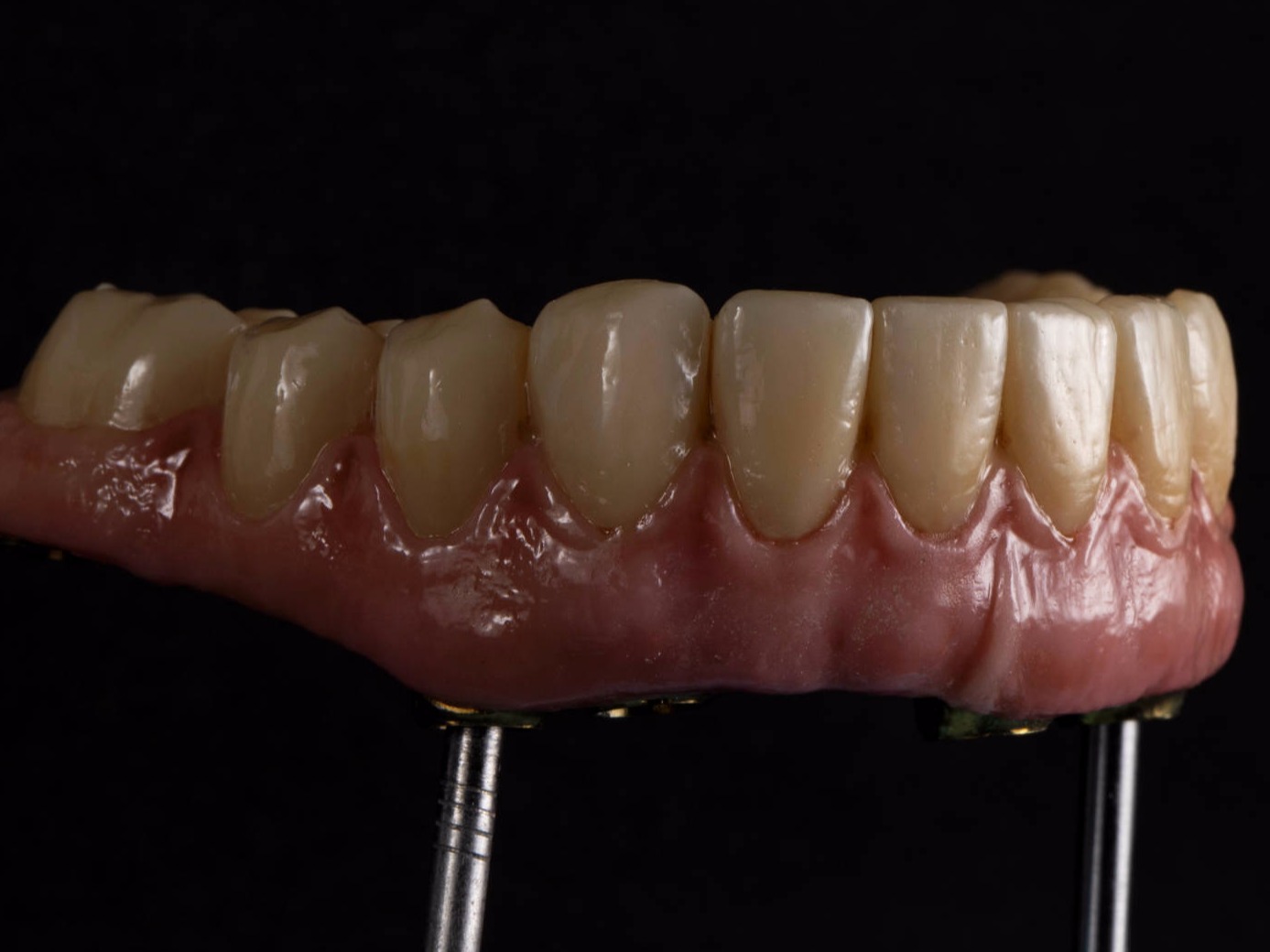 implante, ceramica dental, estetica dental